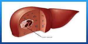 Liver Cancer Treatment