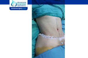 liposuction in Iran