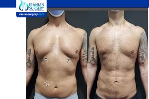 gynecomastia surgery cost in iran