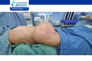 plastic surgery in Iran pictures