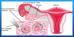 ZIFT Procedure Advantages and Disadvantages