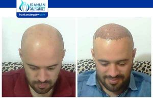 Hair Transplant stages | Hair Transplant growth chart | Iranian Surgery