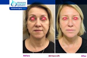 facelift surgery in Iran before and after