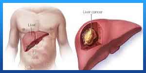 أعراض سرطان الکبد الحمید