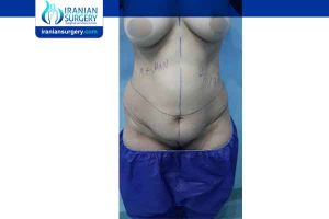 liposuction in Iran