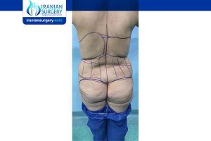 liposuction in iran