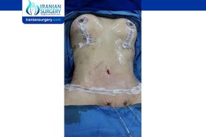 breast implants in Iran