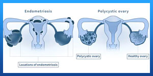 what's the difference between icsi and ivf 