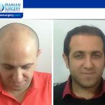 hair transplant in iran
