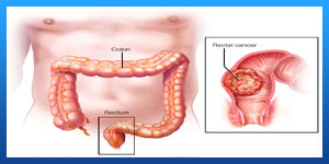 Rectal Cancer Treatment
