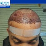 Satisfactory hair transplant results of Filipino patient