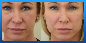 dermal fillers