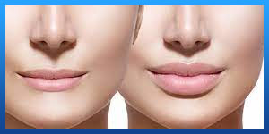 lip augmentation 