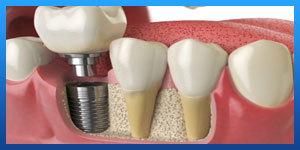 One day dental implants