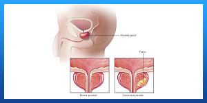 subcapsular orchidectomy