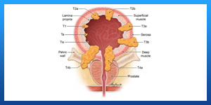 bladder cancer symptoms in men