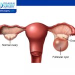 Ovarian Cysts