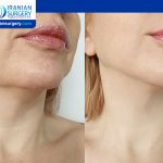 jawline and chin contouring with non-surgical dermal fillers