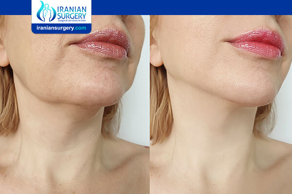 jawline and chin contouring with non-surgical dermal fillers