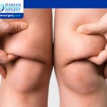 Knee Liposuction