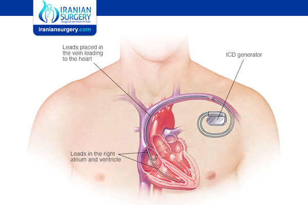 Implantable cardioverter-defibrillators (ICDs)