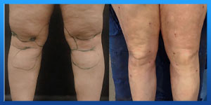 Knee Liposuction