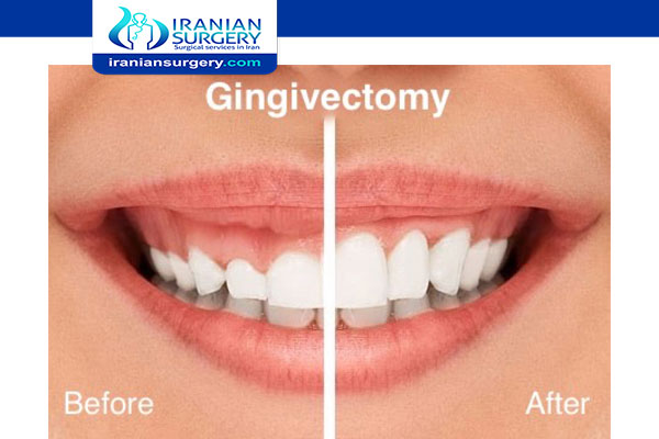 gingivectomy incision