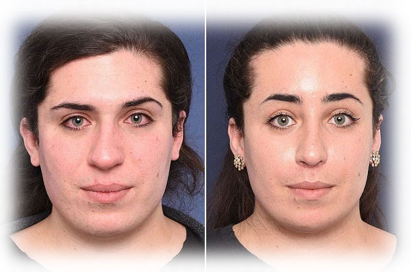 Forehead Reduction surgery