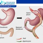 مخاطر عملیة قص المعدة