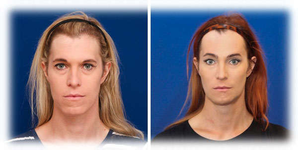 Forehead Reduction surgery