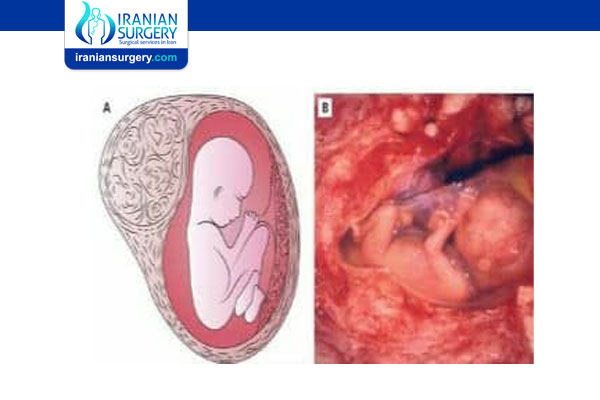 هل الورم الليفي في الرحم يمنع الحمل؟