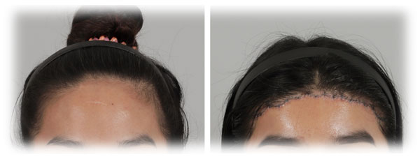 Forehead Reduction surgery