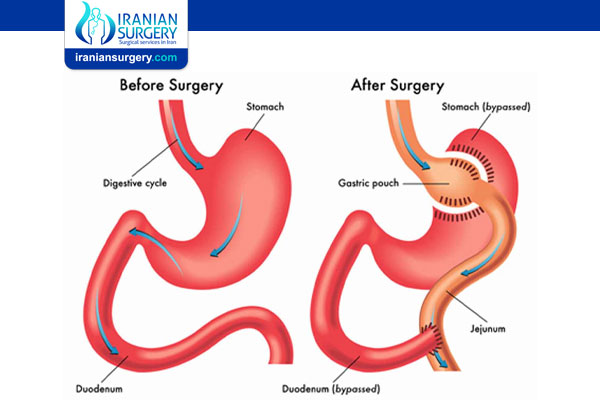 Can Gastric Bypass Surgery Fail