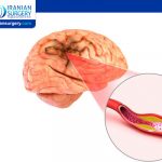 Brain aneurysm