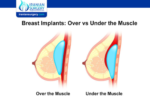 What Are the Breast Implant Placement Options?