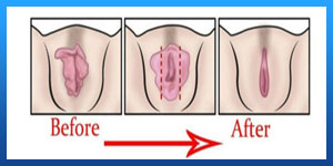 Vaginal Rejuvenation