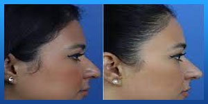 Buccal Fat Removal After Jaw (Orthognathic) Surgery