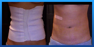 Pain after liposuction