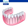 How Soon After a Tooth Extraction Can I Get a Dental Implant?