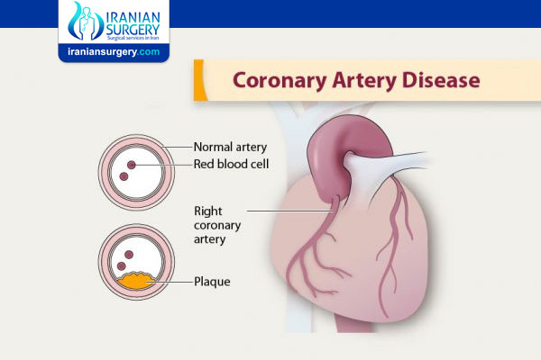 Coronary Artery Disease Diagnosis 