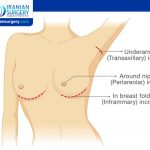 Do Breast Implants Under the Muscle Sag