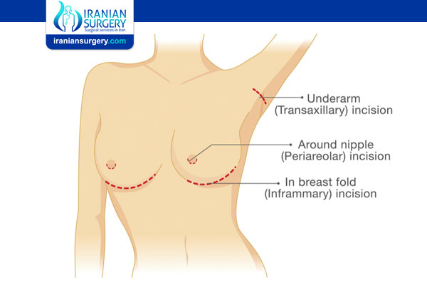 Do Breast Implants Under the Muscle Sag