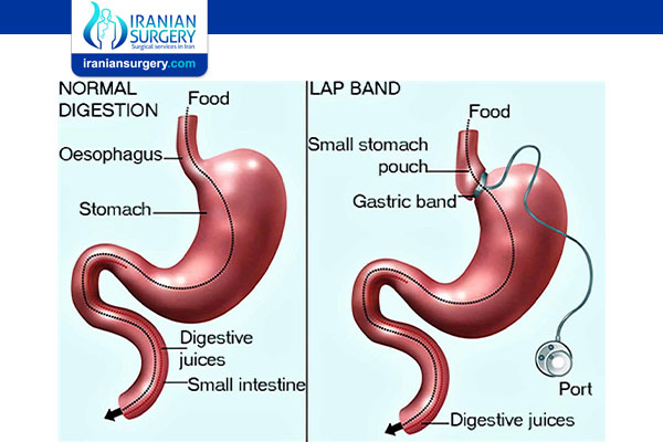 Gastric band surgery in Iran