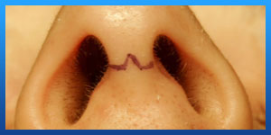 open rhinoplasty scar