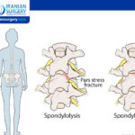 Spondylolysis