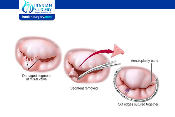 Mitral Valve Repair Vs Replacement