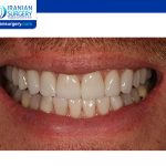 Do permanent veneers look better than temporary?