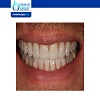 Do permanent veneers look better than temporary?