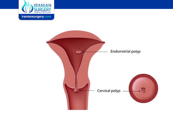 Cervical Polyps