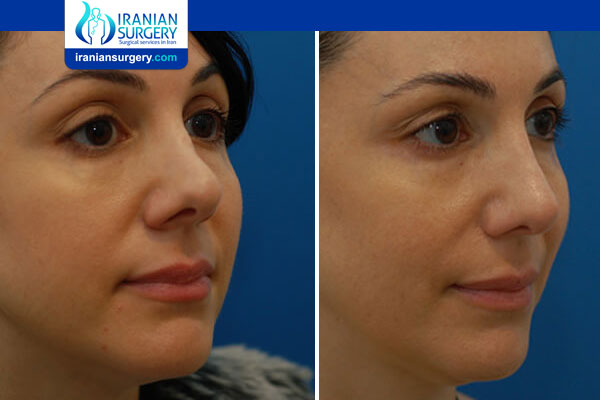 Recovery after Revision Rhinoplasty